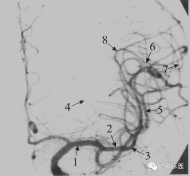 大脑中动脉的分段图解