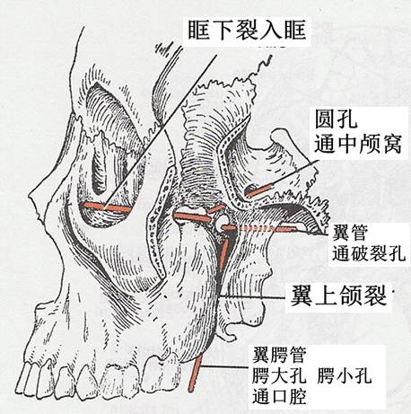 翼突钩增生图片