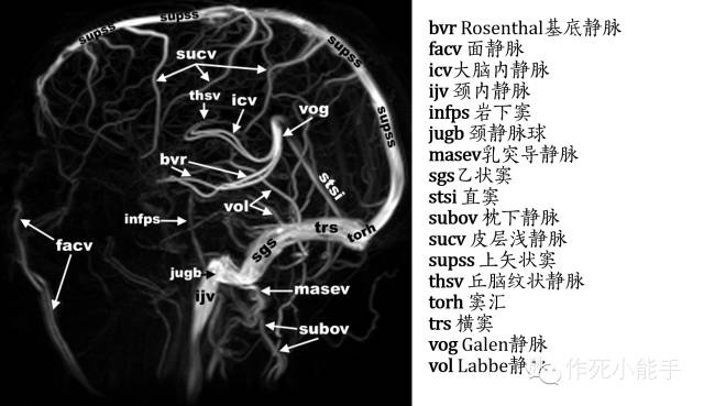 這張突出幕上深靜脈注意深靜脈和大腦腳,鉤之間的解剖關係ctv重建