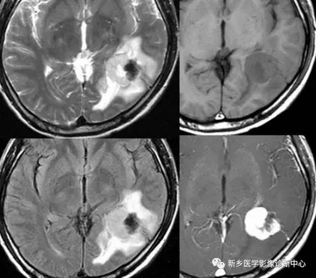 脑膜瘤的分类及各型的影像学表现 脑医汇 神外资讯 神介资讯