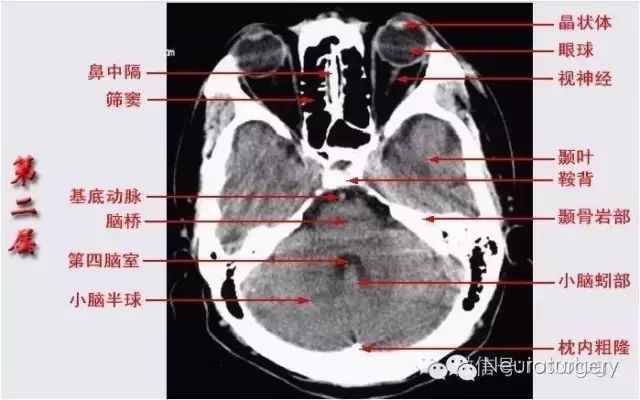 顱腦ct解剖口訣