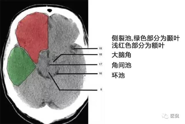 为额叶(frontal lobe)14,鞍背(dorsum sellae)13,桥前池(prepontine
