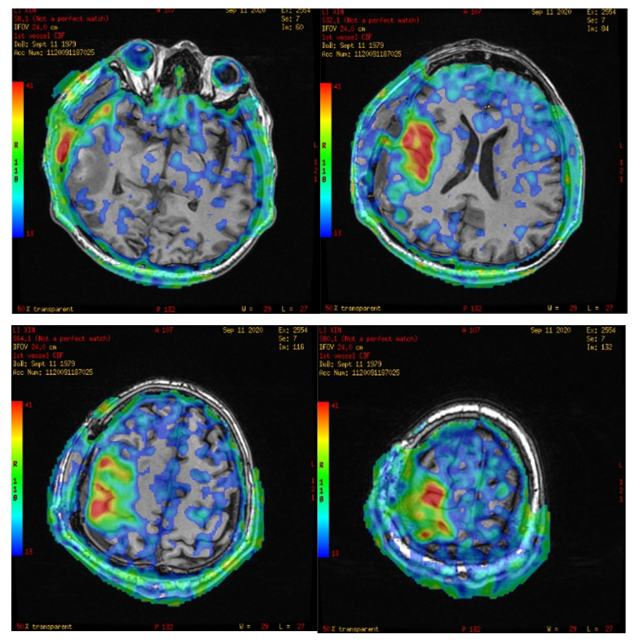 孟慶虎醫生磁共振三維動脈自旋標記腦灌注成像在缺血性腦血管病手術中