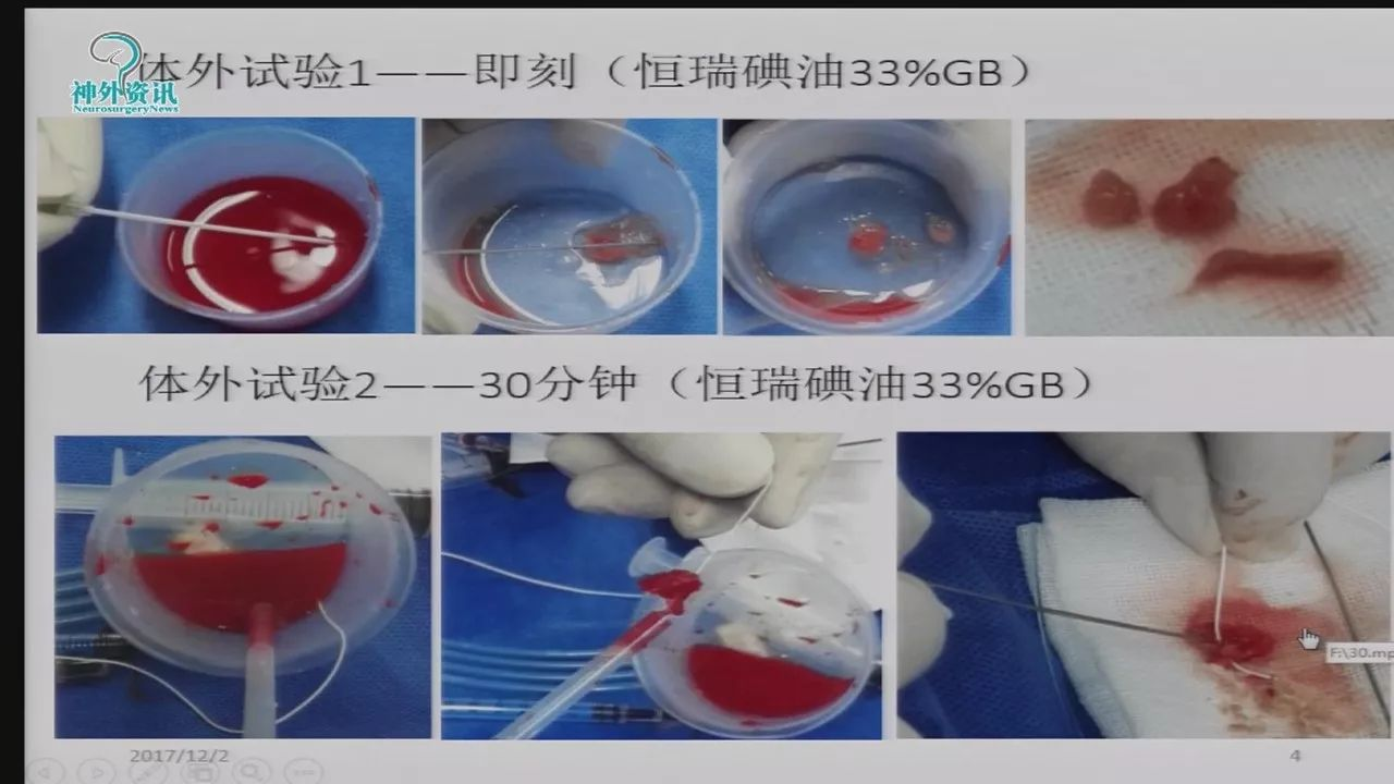 钟书恒瑞碘油在神经介入治疗中的应用丨第七届全国介入医学工程大会