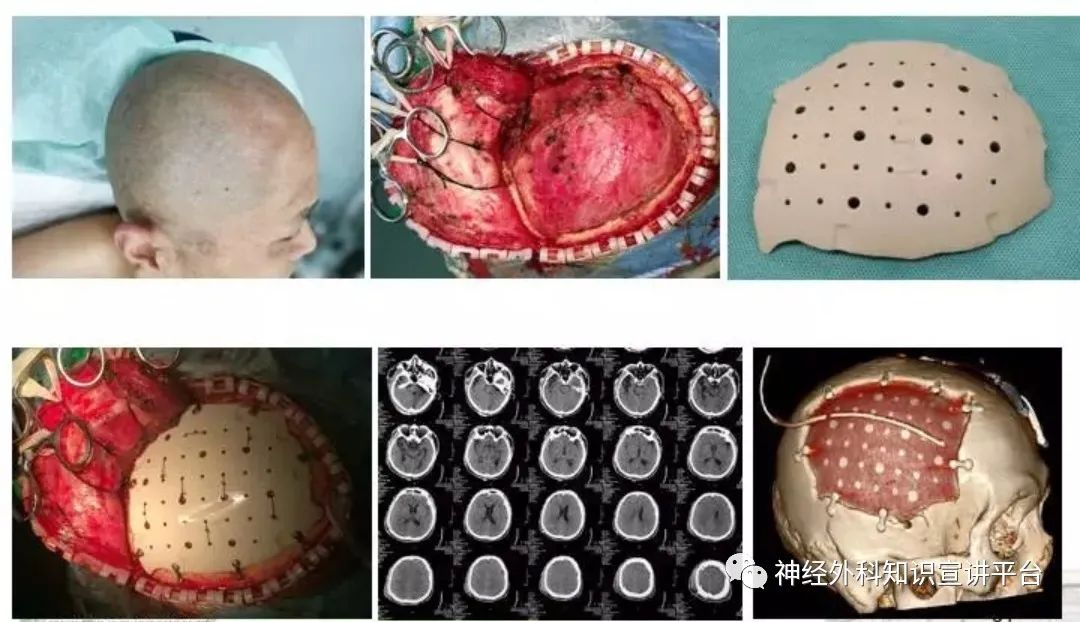 以前去骨瓣减压手术,一般不用人工硬膜修补,而是用颞肌直接缝合在硬膜