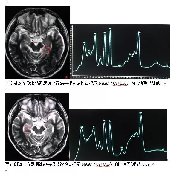 再次针对该区域行磁共振波谱检查提示左侧海马靠近尾端naa/(cr cho)的