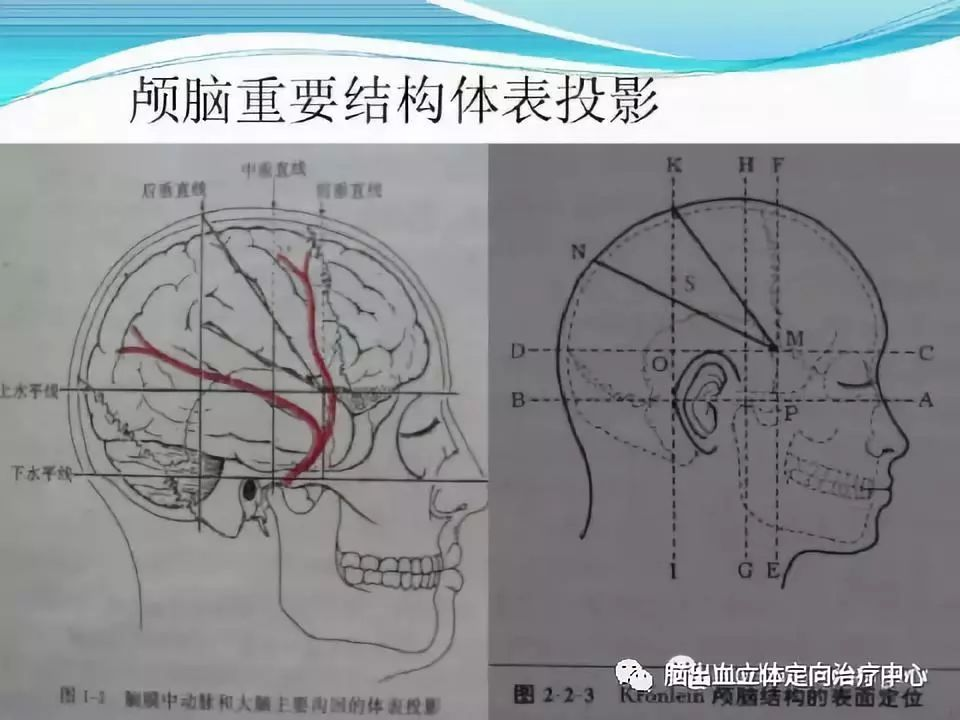 现就颅内血肿定位方法介绍如下:脑出血是神经外科的急危重症.随