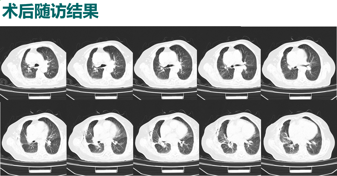 神外“症”道-“宝”护有方优秀病例分享：脑外伤合并严重肺挫伤、肺部感染病例报告 - 脑医汇