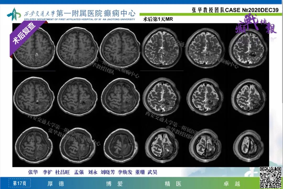 癲戰快報結節性硬化症之左頂致癇灶切除術一例