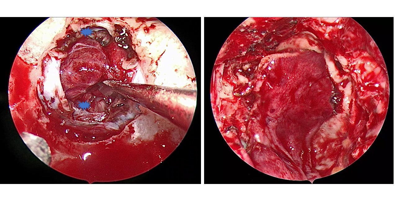 肖顺武教授内镜扩大经鼻经鞍结节入路切除鞍上拉克氏rathkes囊肿