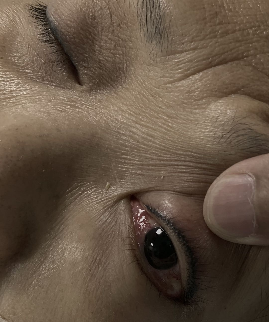 道路艰难无所惧,勇往直前堵瘘口——记一例经岩下窦入路的海绵窦区硬