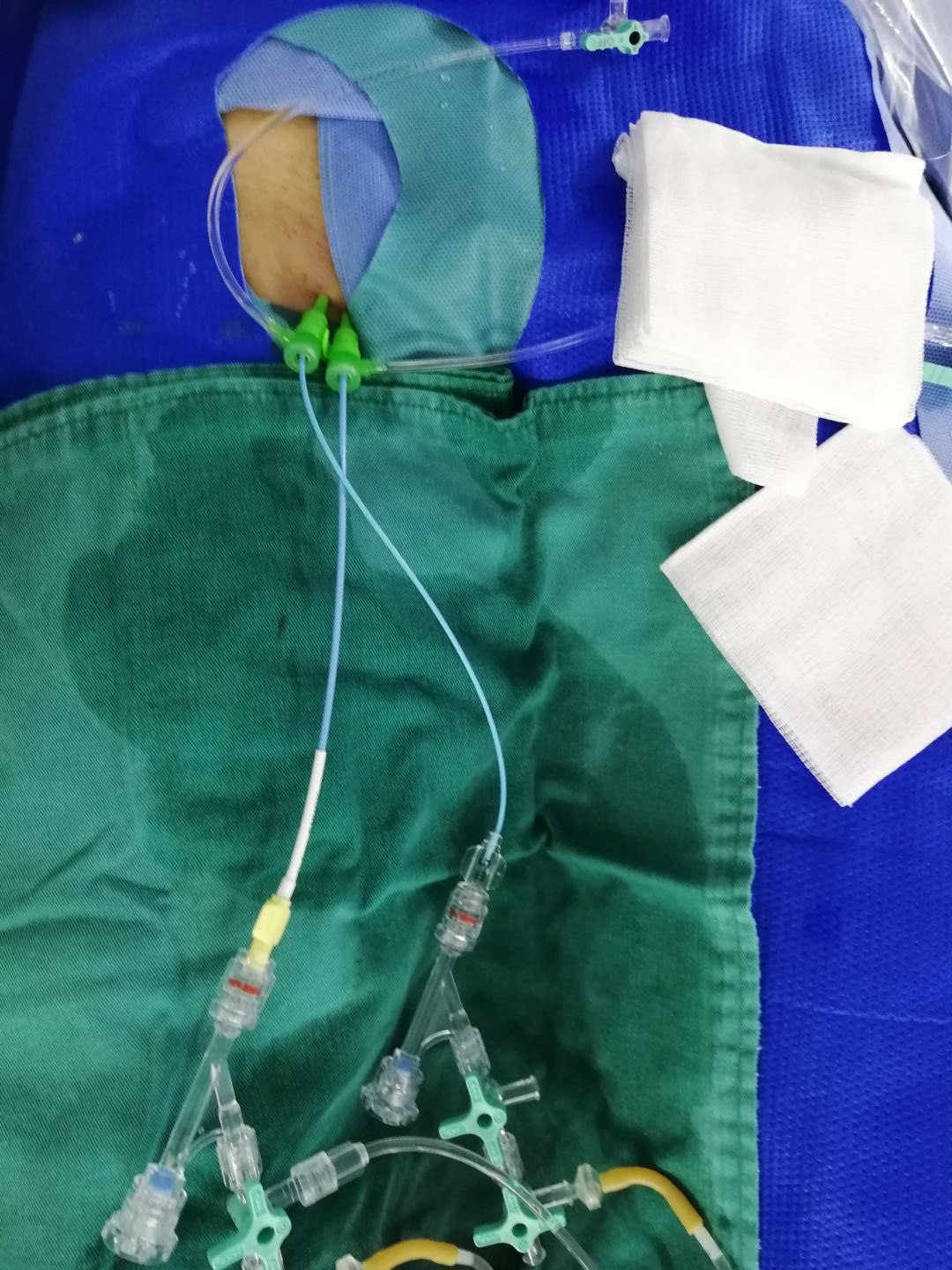 道路艰难无所惧,勇往直前堵瘘口——记一例经岩下窦入路的海绵窦区硬