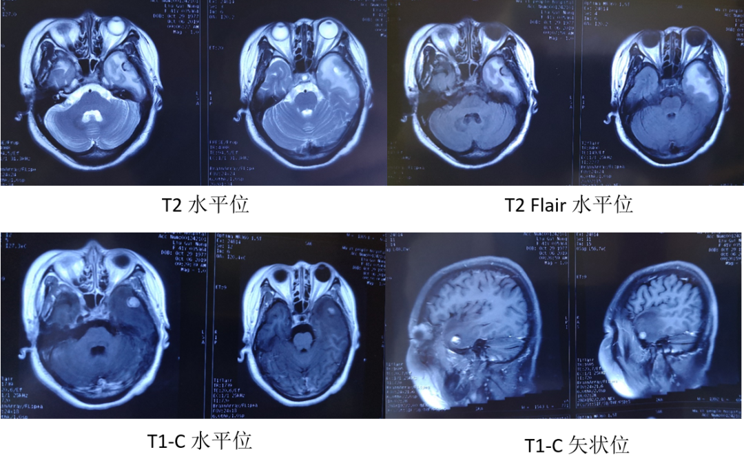 颞叶脑膜瘤图片