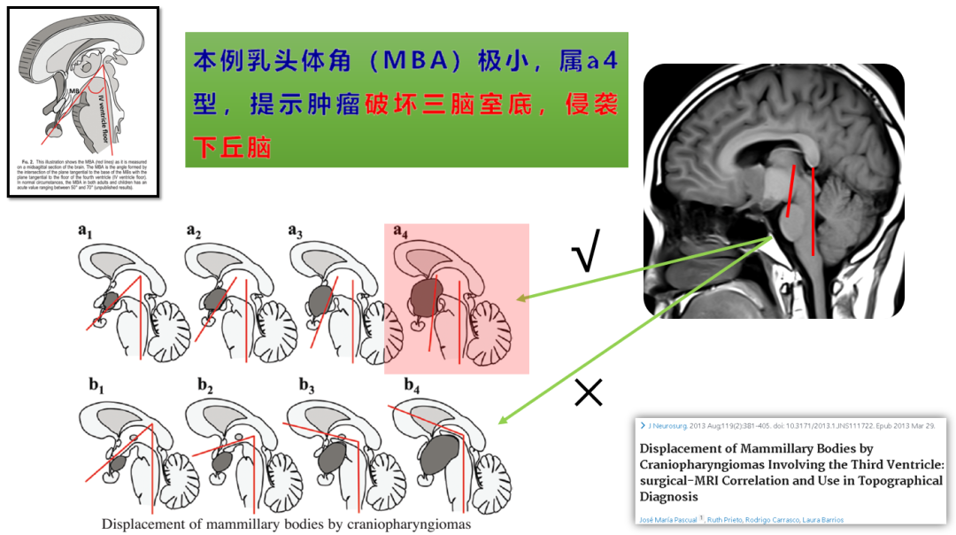 颅咽管瘤解剖位置图片