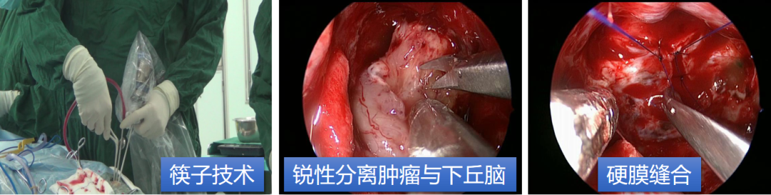 手術過程術後術後核磁增強,冠狀位,腫瘤全切,雙側下丘腦形態可辨(黃色