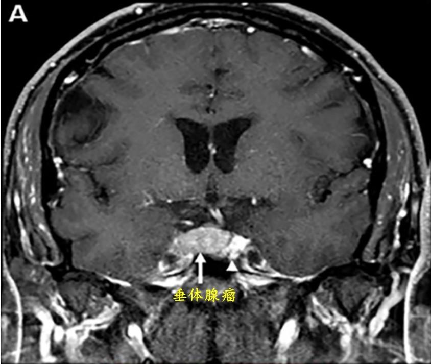 腺瘤(箭頭)可能侵犯右側海綿竇內側壁並使垂體向左移位(小箭頭所示)