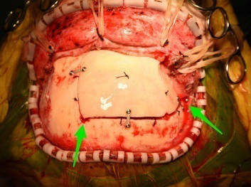 首都医科大学三博脑科医院周忠清主任团队经鼻内镜手术后复发颅咽管瘤