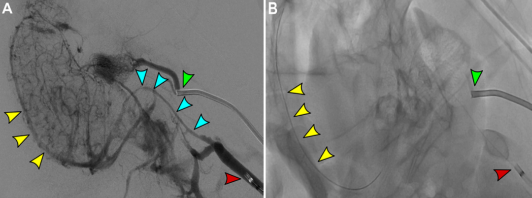 一种用于测试颅内静脉窦血栓机械取栓和血管内成像的临床前模型