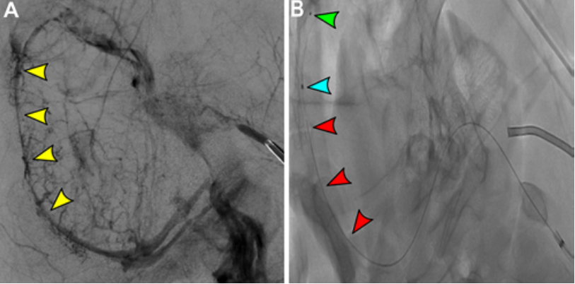 一种用于测试颅内静脉窦血栓机械取栓和血管内成像的临床前模型