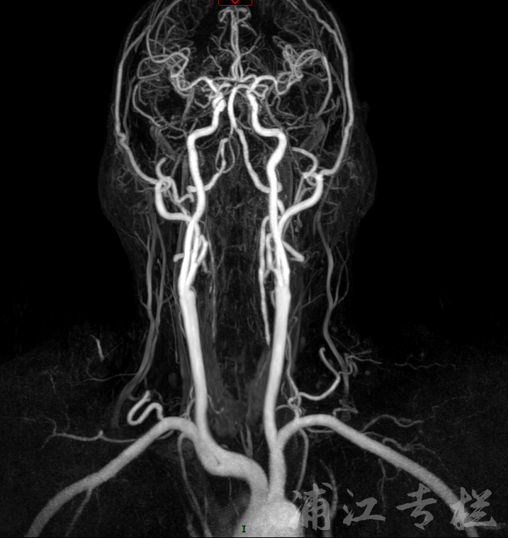 浦江脑血管病专栏丨慢性椎动脉v1段闭塞逆行开通病例介绍