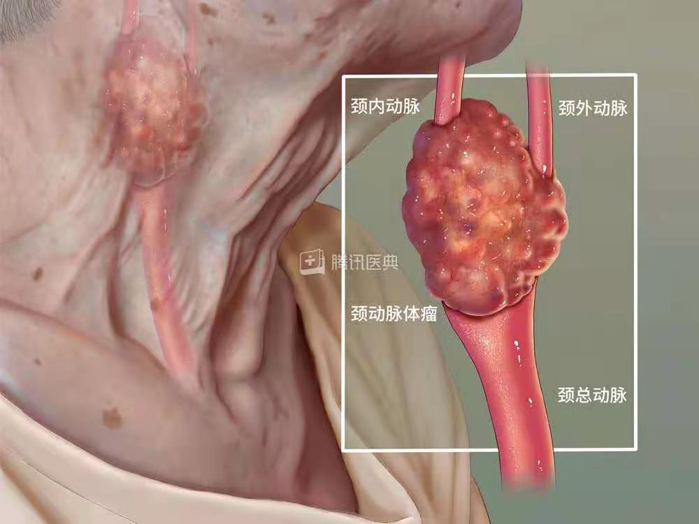 颈动脉体瘤位置图片图片