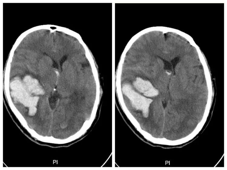 这是一例很危重的病例,脑室完全被血肿铸型,生命垂危,后来cta证实为