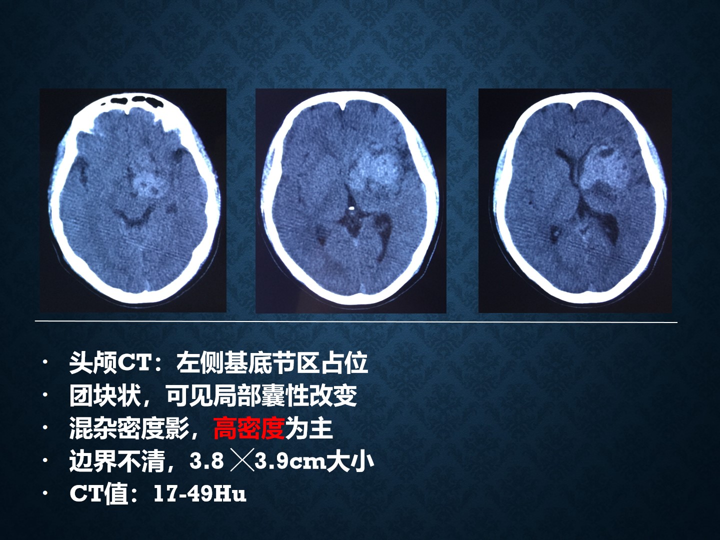 基底节生殖细胞瘤图片