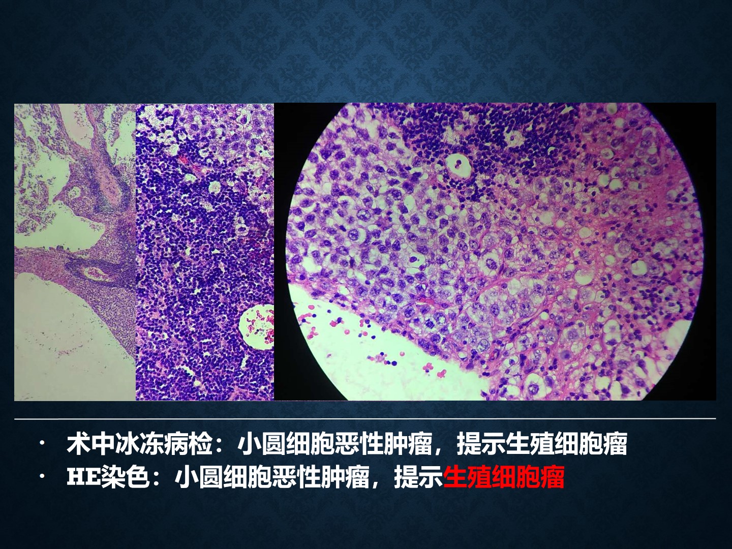基底节生殖细胞瘤图片