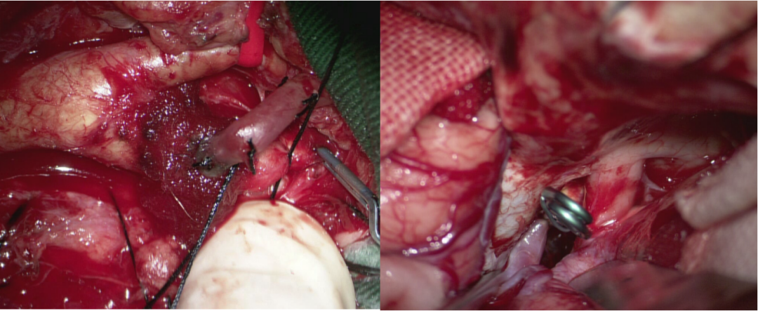 手術過程治療方案:左側頸內動脈-橈動脈-大腦中動脈搭橋術聯合動脈瘤