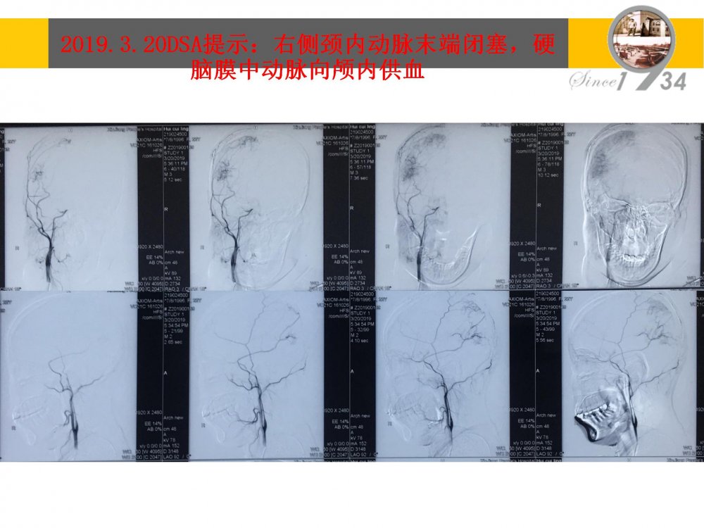 颞浅动脉大脑中动脉搭桥治疗颈内动脉末端闭塞_05.jpg