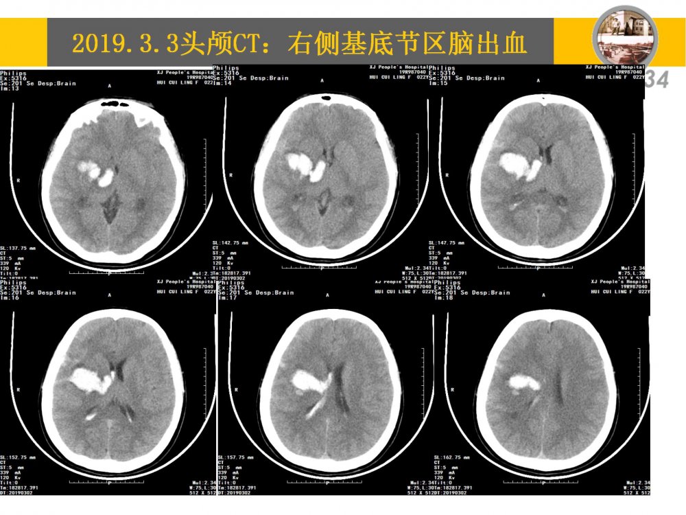 颞浅动脉大脑中动脉搭桥治疗颈内动脉末端闭塞_03.jpg