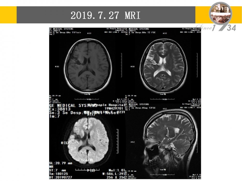 颞浅动脉大脑中动脉搭桥治疗颈内动脉末端闭塞_07.jpg