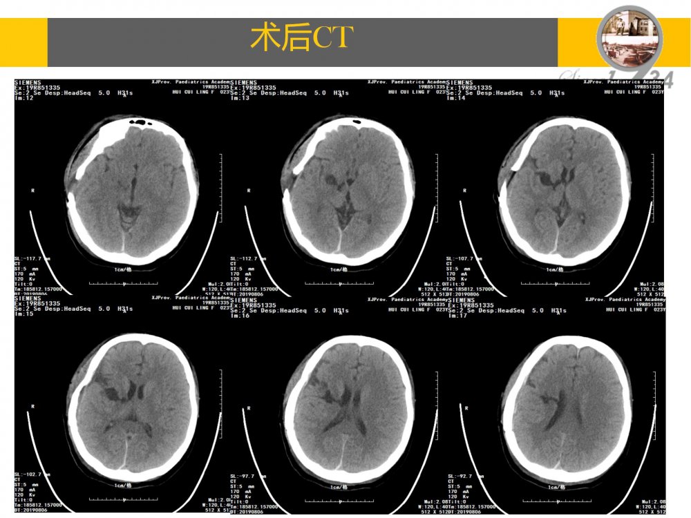 颞浅动脉大脑中动脉搭桥治疗颈内动脉末端闭塞_12.jpg