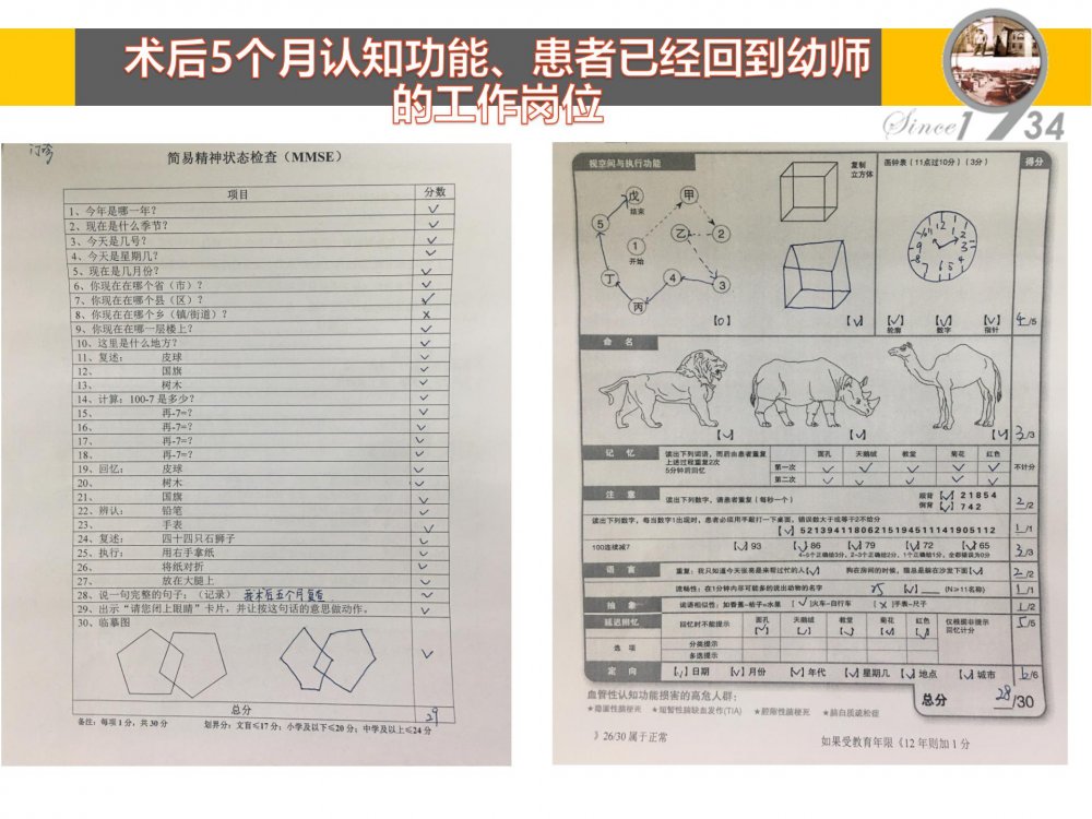 颞浅动脉大脑中动脉搭桥治疗颈内动脉末端闭塞_17.jpg