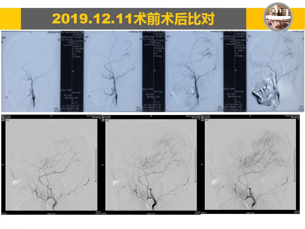 颞浅动脉大脑中动脉搭桥治疗颈内动脉末端闭塞_16.jpg