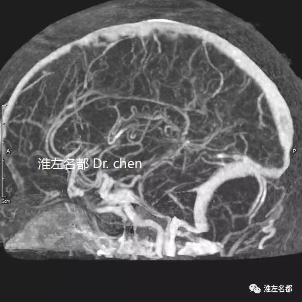 和大腦內靜脈(彎箭)高密度徵,提示急性血栓形成.