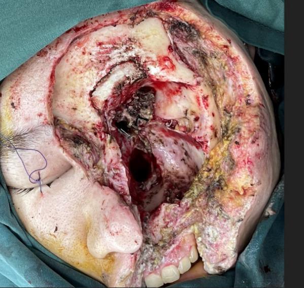 颅底恶性肿瘤切除游离瓣修复1例