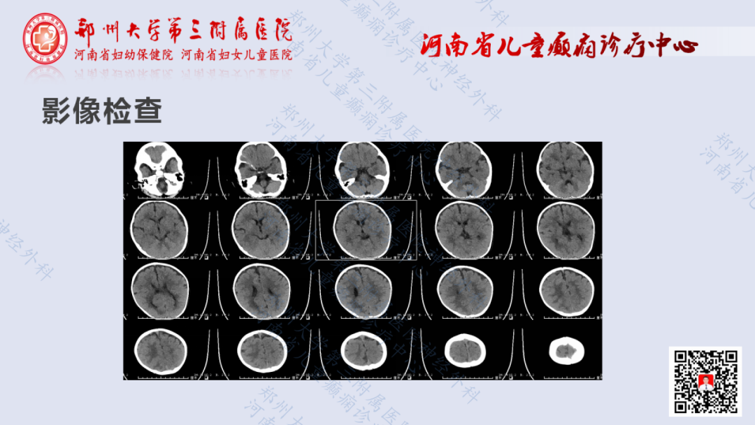 《术战癫峰》第6期:半侧巨脑症一例