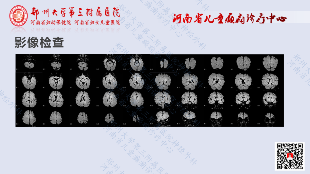 术战癫峰第6期半侧巨脑症一例