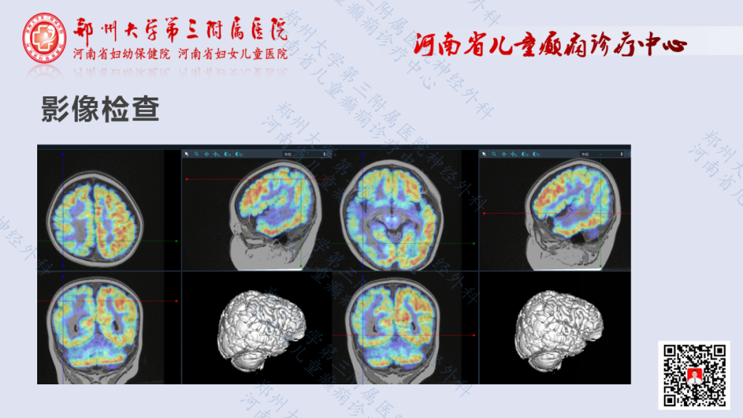 術戰癲峰第6期半側巨腦症一例