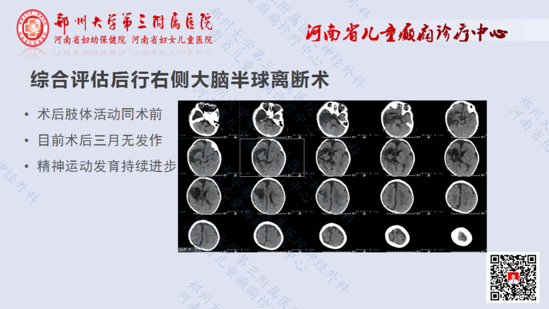 术战癫峰第6期半侧巨脑症一例