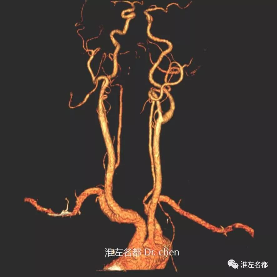 椎基底动脉血管图片图片
