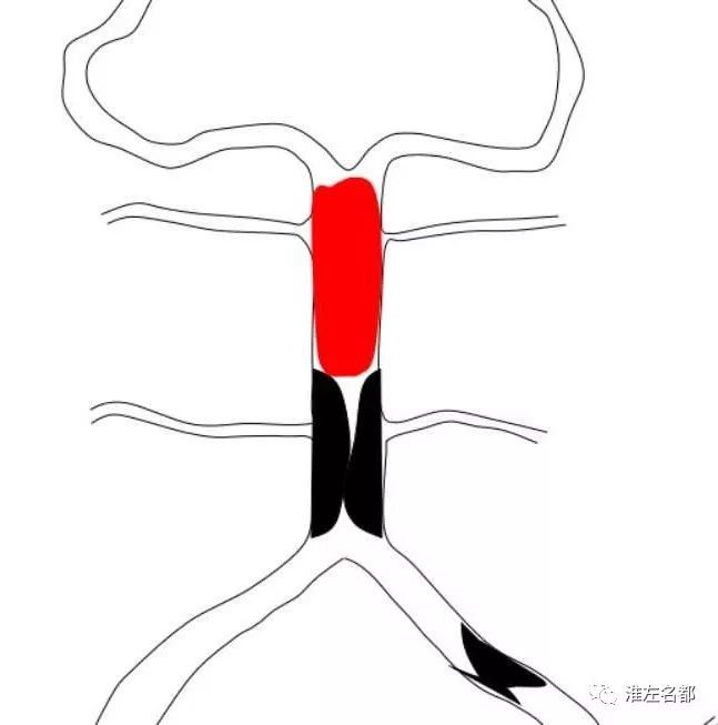 3,高血壓2,基底動脈閉塞1,腦梗死(雙側腦幹)臨床診斷△ctp靜脈早期