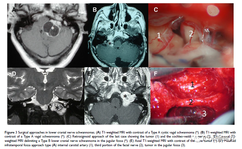 【综述】非前庭颅底和颅内神经鞘瘤的治疗趋势