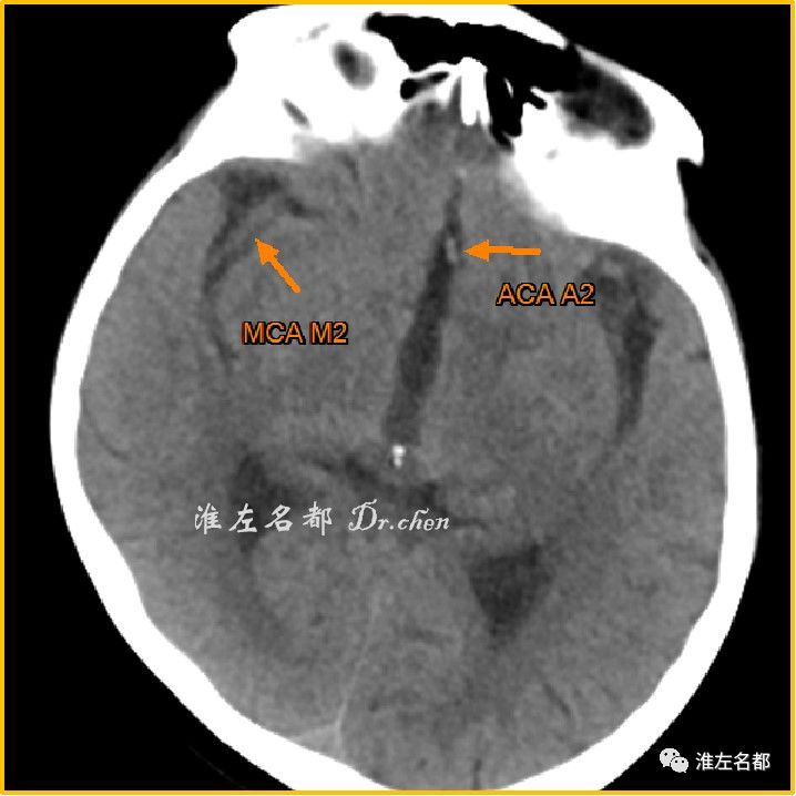 正常脑动脉ct表现va:椎动脉pca:大脑后动脉mca:大脑中动脉ica:颈