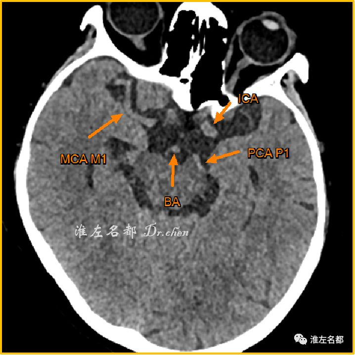 腦動脈ct高密度徵診斷溶栓和取栓