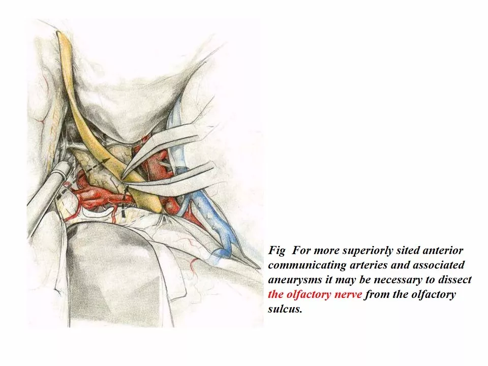 神经外科手术入路十七翼点入路上