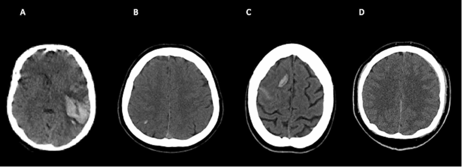 皮質旁小出血灶 20mm(juxta-cortical hemorrhage,jch),硬膜下出血