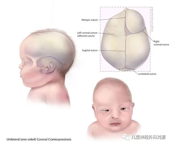 人字缝早闭斜头图片图片