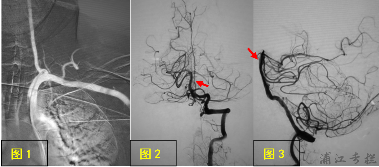 envoy da導引導管(codman公司)置入左側椎動脈起始段(圖1),造影見基底
